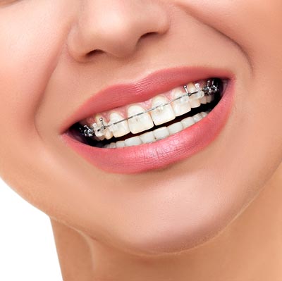 advanced technology braces