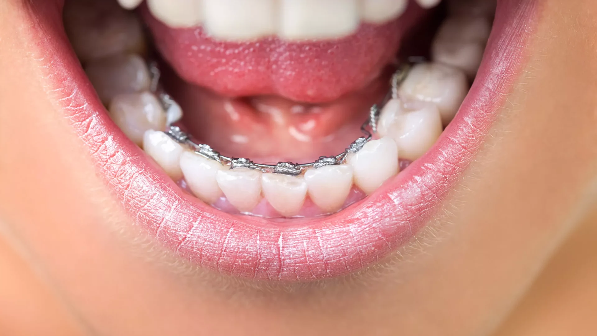 lingual braces near me