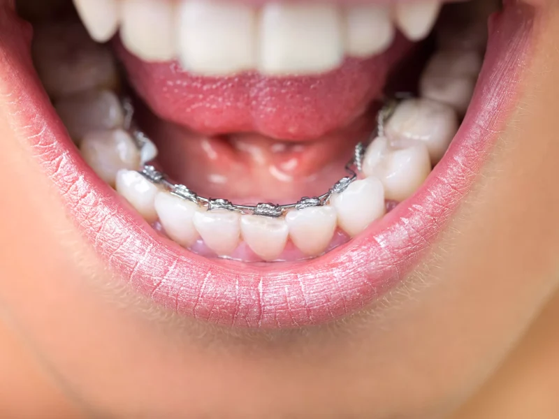 lingual braces near me