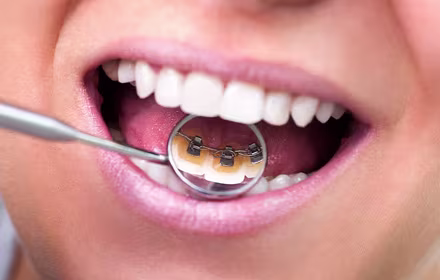Lingual Braces
