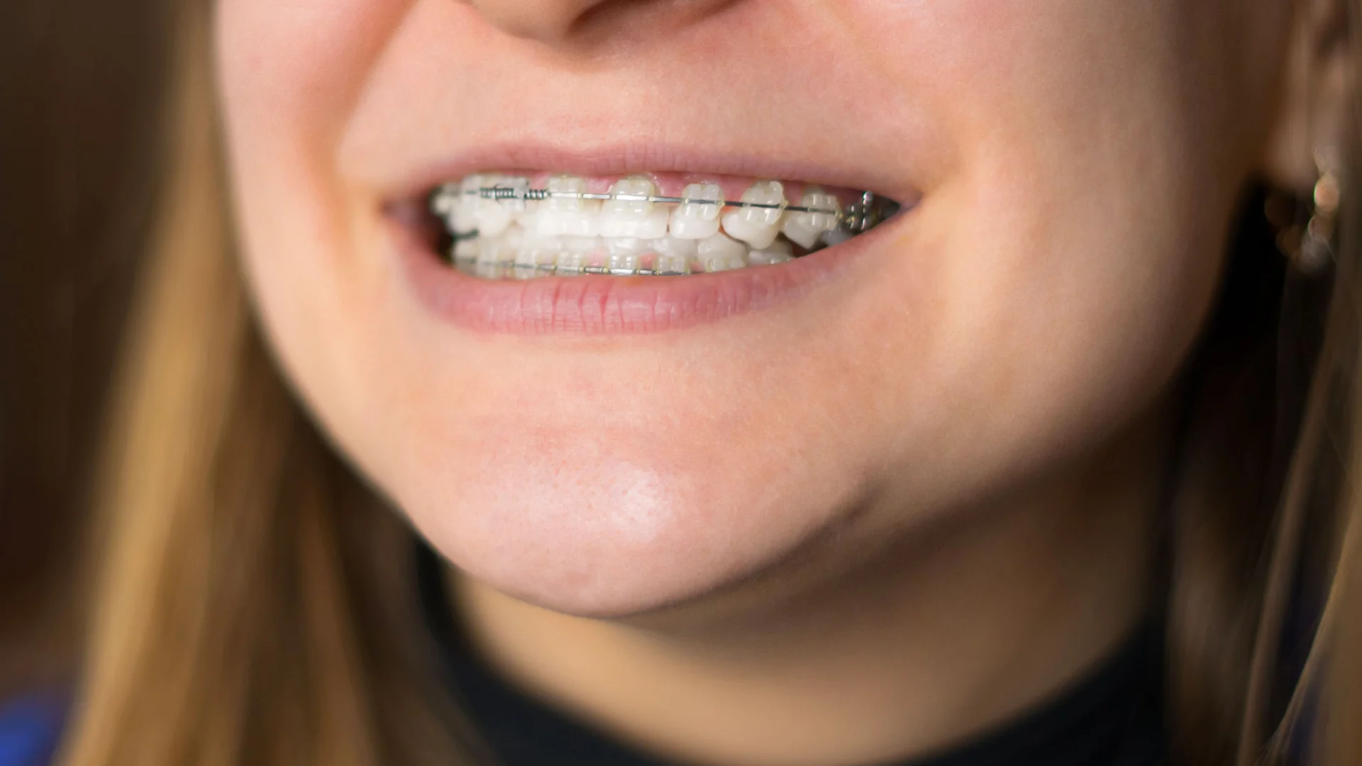 clear braces Reno NV