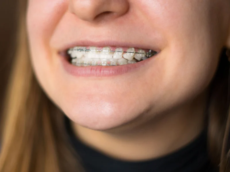 clear braces Reno NV